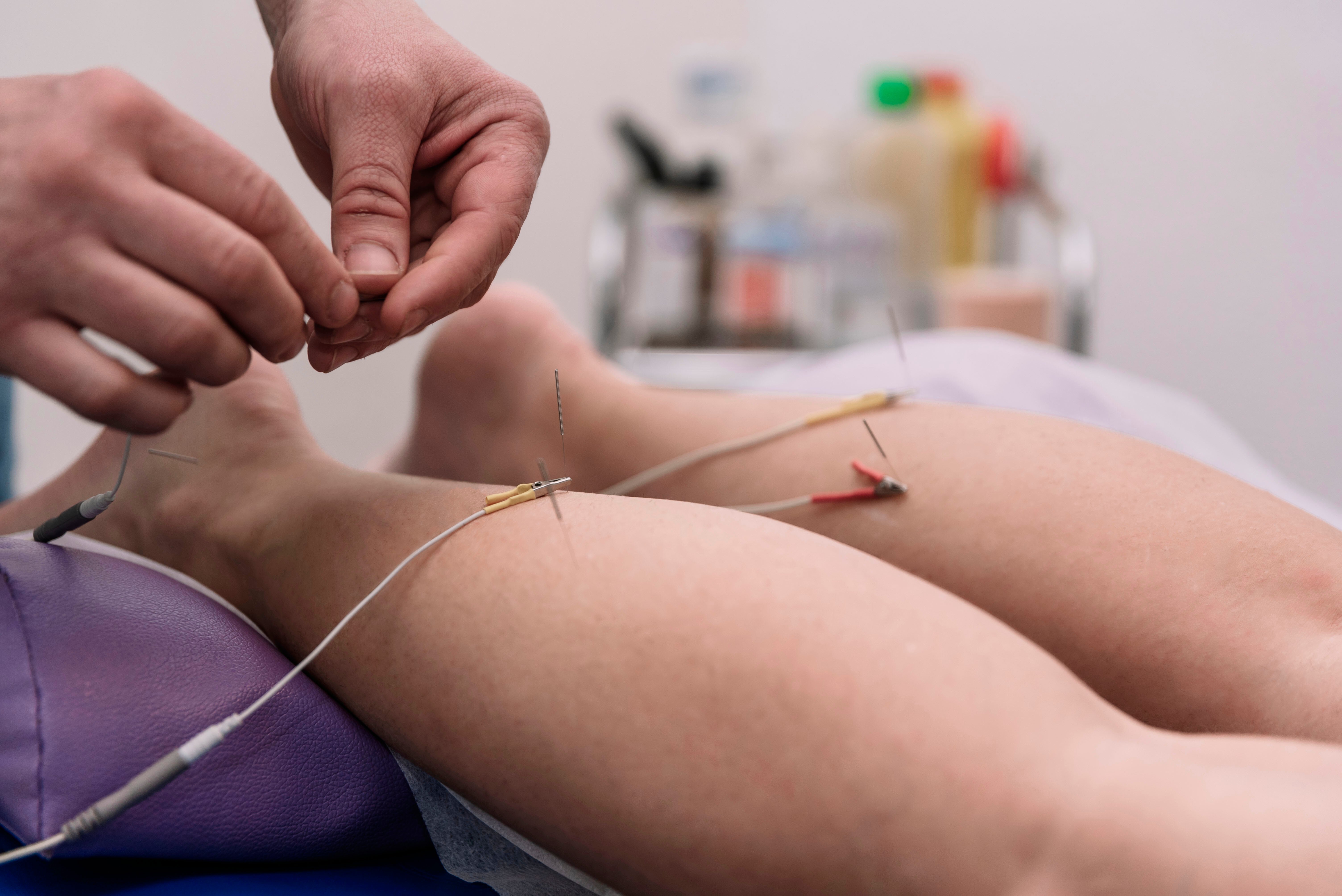 dry-needling