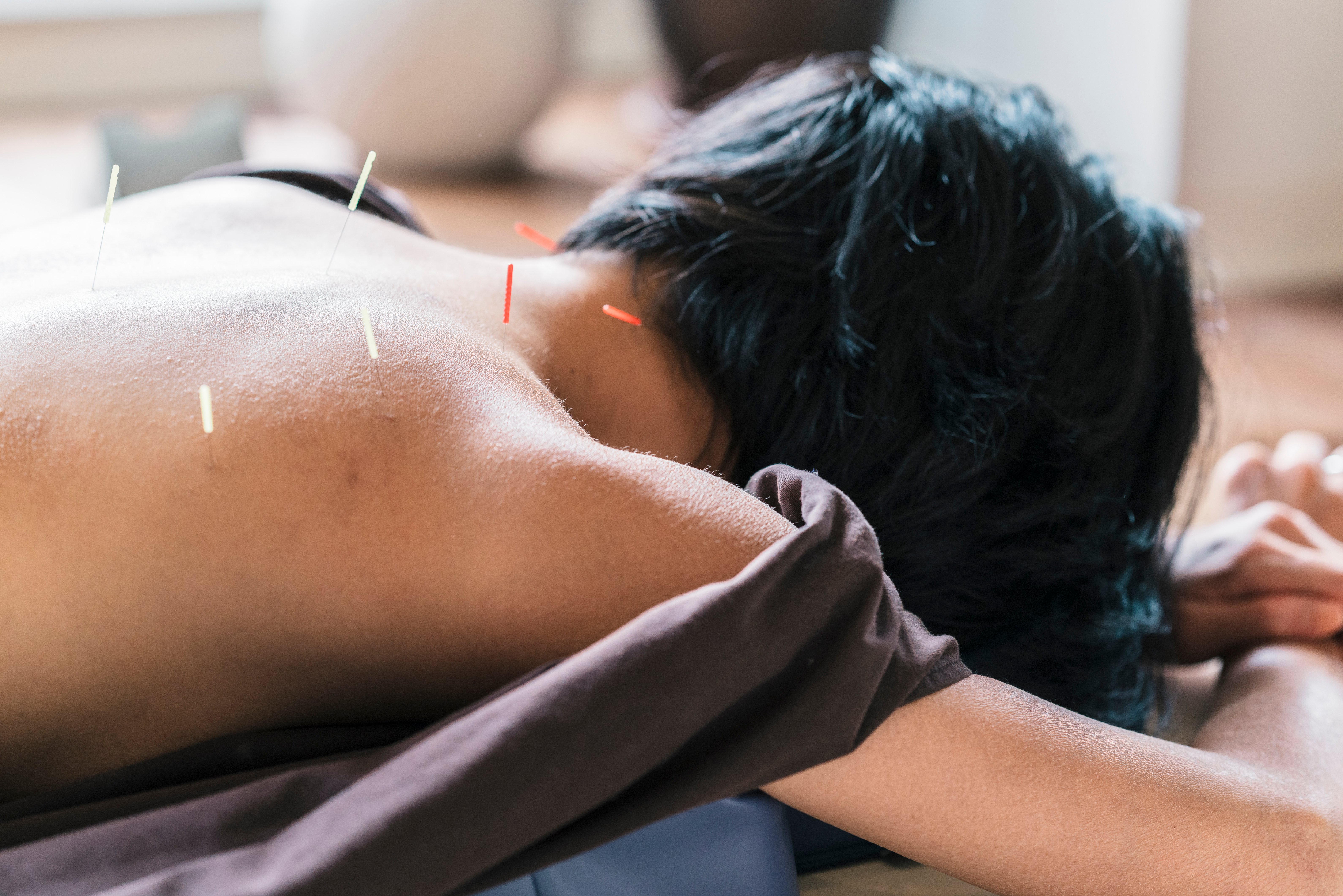 dry-needling-chronic-pain