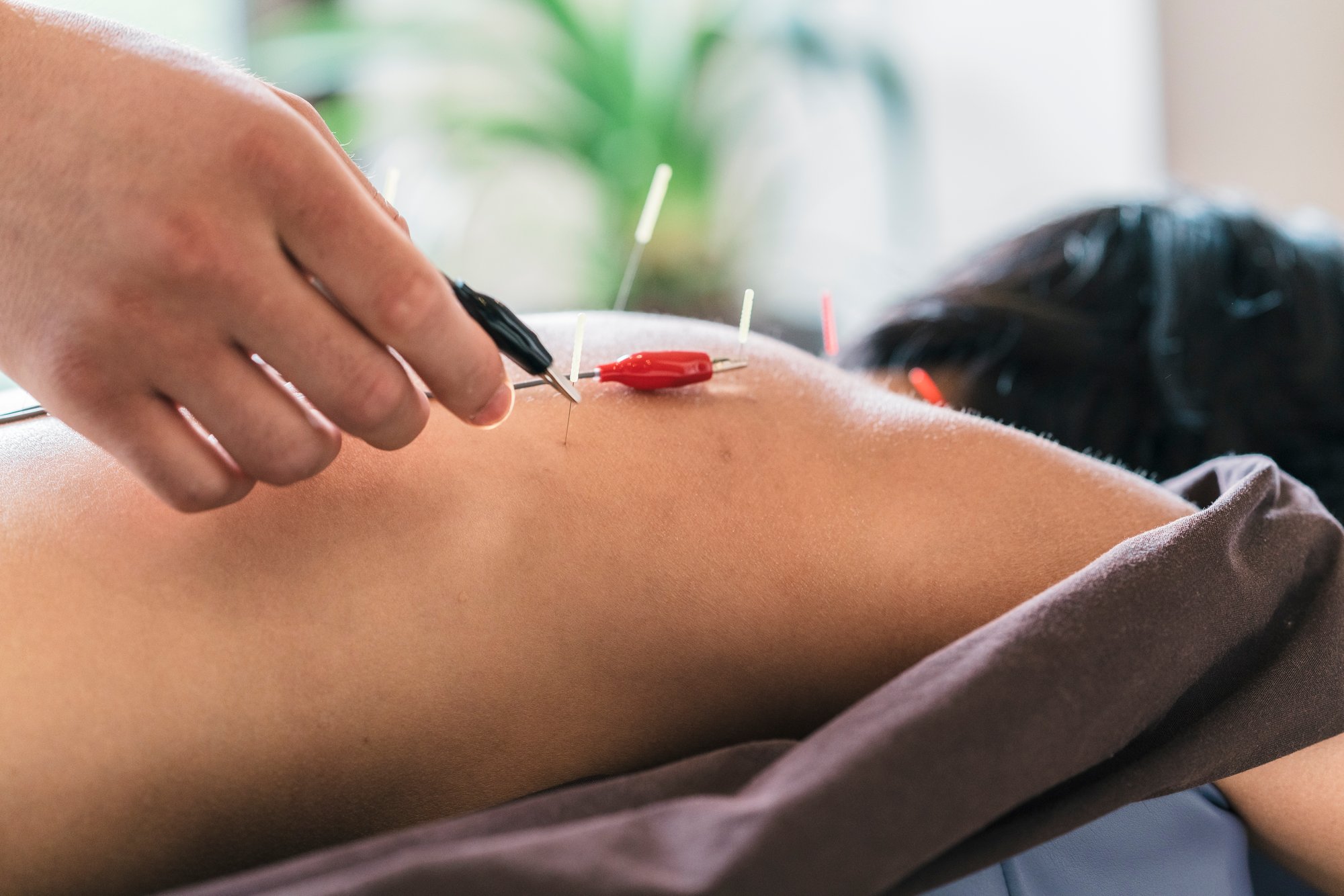 therapist-giving-cupping-treatment-to-young-asian-2024-09-22-06-29-46-utc (2)